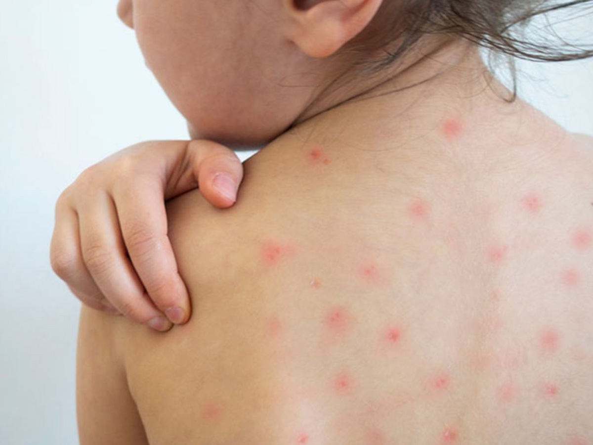 Sarampión: una enfermedad altamente contagiosa que requiere vigilancia permanente